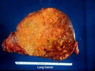 Lung Cancer 
 