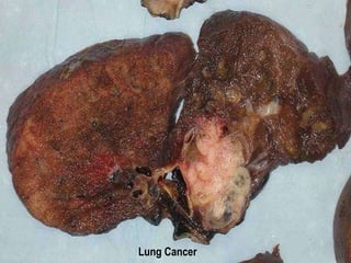 Lung Cancer 
 