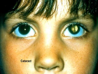 Cataract 
 