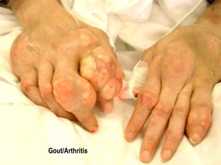 Gout/Arthritis 
 