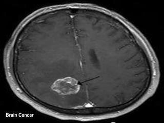 Brain Cancer 
 