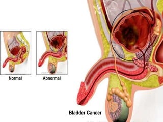 Bladder Cancer 
 