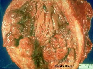 Bladder Cancer 
 