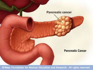 Pancreatic Cancer 
 