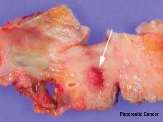 Pancreatic Cancer 
 