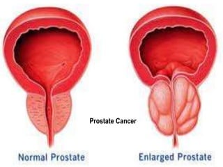 Prostate Cancer 
 