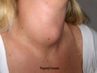 Thyroid Cancer 
 