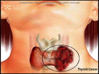 Thyroid Cancer 
 