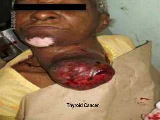 Thyroid Cancer 
 