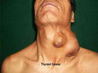 Thyroid Cancer 
 