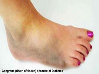 Gangrene (death of tissue) because of Diabetes 
 