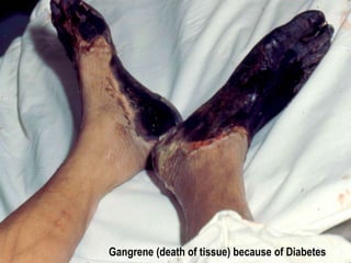 Gangrene (death of tissue) because of Diabetes 
 