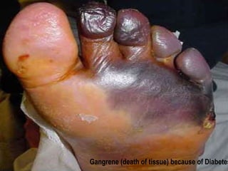 Gangrene (death of tissue) because of Diabetes 
 