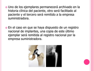  Uno de los ejemplares permanecerá archivado en la
historia clínica del paciente, otro será facilitado al
paciente y el tercero será remitido a la empresa
suministradora.
 En el caso en que se haya dispuesto de un registro
nacional de implantes, una copia de este último
ejemplar será remitida al registro nacional por la
empresa suministradora.
 