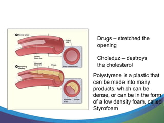 Drugs – stretched the
 opening

 Choleduz – destroys
 the cholesterol
Polystyrene is a plastic that
can be made into many
products, which can be
dense, or can be in the form
of a low density foam, called
Styrofoam
 