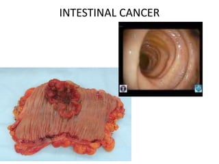 INTESTINAL CANCER
 
