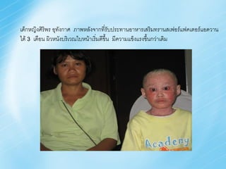 เด็กหญิงศิริพร อุทงกาศ ภาพหลังจากที่รับประทานอาหารเสริมทรานสเฟอร์แฟคเตอร์แอดวาน
                  ั
ได้ 3 เดือน ผิวหนังบริเวณใบหน้าเริ่มดีขึ้น มีความแข็งแรงขึ้นกว่าเดิม
 