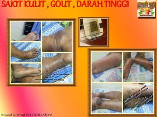 Prepared By ROYAL SWEETENER STEVIA
SAKIT KULIT , GOUT , DARAH TINGGI
 