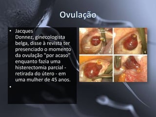 • Jacques
  Donnez, ginecologista
  belga, disse à revista ter
  presenciado o momento
  da ovulação "por acaso"
  enquanto fazia uma
  histerectomia parcial -
  retirada do útero - em
  uma mulher de 45 anos.
•
 