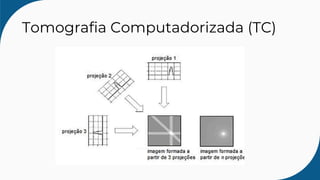 Tomografia Computadorizada (TC)
 
