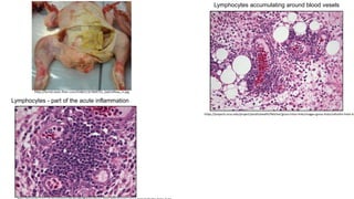 http://farm6.static.flickr.com/5548/11327609753_2ab514feaa_m.jpg
https://projects.ncsu.edu/project/poultryhealth/fletcher/gross-histo-links/images-gross-histo/cellulitis-histo-4.
Lymphocytes accumulating around blood vesels
Lymphocytes - part of the acute inflammation
 