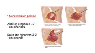 • Nörovasküler pedikül
Aksiller çizginin 8-10
cm inferioru
Kasın ant kenarının 2-3
cm laterali
 