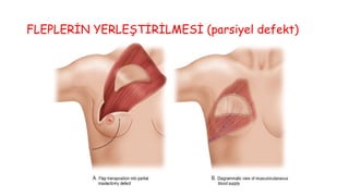 FLEPLERİN YERLEŞTİRİLMESİ (parsiyel defekt)
 