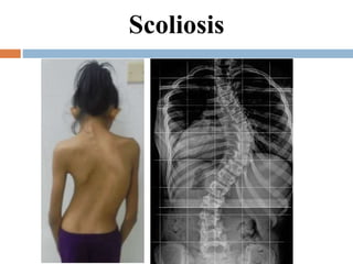 Scoliosis
 