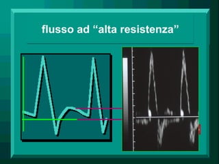 flusso ad “alta resistenza”
• arterie periferiche
• carotide esterna
• alcuni flussi
“tumorali”
basso flusso diastolico
 