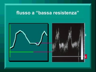 flusso a “bassa resistenza”
• arterie cerebrali
• arterie renali
• arterie parenchimali
• flogosi (iperemia)
flusso diastolico elevato
 