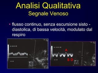 • flusso continuo, senza escursione sisto -
diastolica, di bassa velocità, modulato dal
respiro
Analisi Qualitativa
Segnale Venoso
A
S D
 