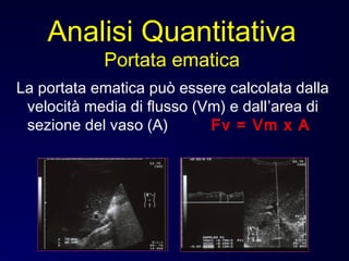 La portata ematica può essere calcolata dalla
velocità media di flusso (Vm) e dall’area di
sezione del vaso (A) Fv = Vm x A
Analisi Quantitativa
Portata ematica
 