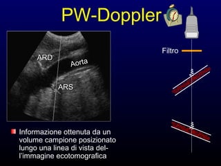 =
PW-Doppler
Informazione ottenuta da un
volume campione posizionato
lungo una linea di vista del-
l’immagine ecotomografica
AortaARDARD
ARSARS
Filtro
 