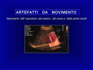 ARTEFATTI DA MOVIMENTO
Dipendenti dallDipendenti dall’ operatore, dal respiro, dal cuore e dalle pareti vasali’ operatore, dal respiro, dal cuore e dalle pareti vasali
 