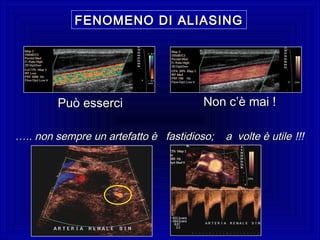 FENOMENO DI ALIASINGFENOMENO DI ALIASING
Può esserciPuò esserci Non cNon c’è mai !’è mai !
…….. non sempre un artefatto è fastidioso; a volte è utile.. non sempre un artefatto è fastidioso; a volte è utile !!!
 