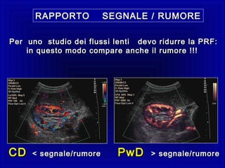 RAPPORTO SEGNALE / RUMORERAPPORTO SEGNALE / RUMORE
CDCD < segnale/rumore< segnale/rumore PwDPwD > segnale/rumore> segnale/rumore
Per uno studio dei flussi lenti devo ridurre la PRF:Per uno studio dei flussi lenti devo ridurre la PRF:
in questo modo compare anche il rumore !!!in questo modo compare anche il rumore !!!
 