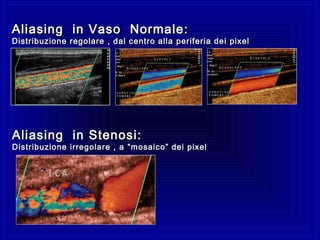 Aliasing in Vaso Normale:Aliasing in Vaso Normale:
Distribuzione regolare , dal centro alla periferia dei pixelDistribuzione regolare , dal centro alla periferia dei pixel
Aliasing in Stenosi:Aliasing in Stenosi:
Distribuzione irregolare , aDistribuzione irregolare , a “mosaico” dei pixel“mosaico” dei pixel
 