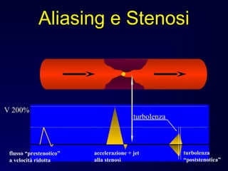 turbolenza
V 200%
flusso “prestenotico”
a velocità ridotta
accelerazione + jet
alla stenosi
turbolenza
“poststenotica”
Aliasing e Stenosi
 