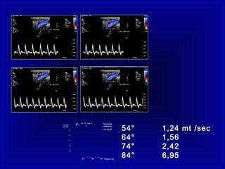 54° 1,24 mt /sec54° 1,24 mt /sec
64° 1,5664° 1,56
74° 2,4274° 2,42
84° 6,9584° 6,95Angolo (ø)
Velocità
cm/ sec
30 60 90
40° 50°
60
50
250
200
150
100
70° 80°
FunzioneFunzione
cosenicacosenica
tra V etra V e øø
2v Fi cos ø
cF=
 
