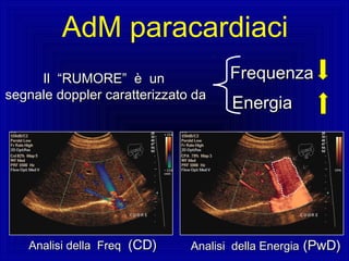 Analisi della FreqAnalisi della Freq (CD)(CD) Analisi della EnergiaAnalisi della Energia (PwD)(PwD)
IlIl “RUMORE” è un“RUMORE” è un
segnale doppler caratterizzato dasegnale doppler caratterizzato da
FrequenzaFrequenza
EnergiaEnergia
AdM paracardiaci
 