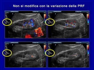 Non si modifica con la variazione della PRF
 