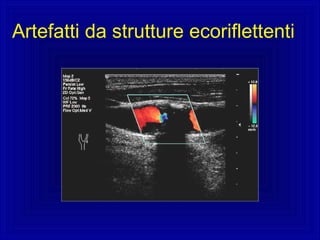 Artefatti da strutture ecoriflettenti
 