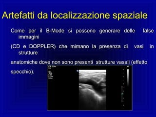 Come per il B-Mode si possono generare delle falseCome per il B-Mode si possono generare delle false
immaginiimmagini
(CD e DOPPLER) che mimano la presenza di vasi in(CD e DOPPLER) che mimano la presenza di vasi in
strutturestrutture
anatomiche dove non sono presenti strutture vasali (effettoanatomiche dove non sono presenti strutture vasali (effetto
specchio).specchio).
Artefatti da localizzazione spaziale
 