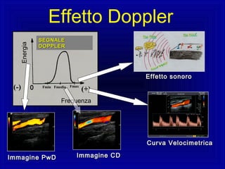 Energia
Frequenza
Fmin Fmedia Fmax
(+)(-) 0
SEGNALESEGNALE
DOPPLERDOPPLER
Effetto sonoroEffetto sonoro
Curva VelocimetricaCurva Velocimetrica
Immagine CDImmagine CDImmagine PwDImmagine PwD
Effetto Doppler
 