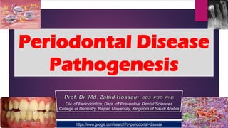 Periodontal Disease
Pathogenesis
https://www.google.com/search?q=periodontal+disease
 