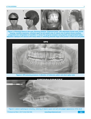 Professional Med J 2017;24(2):352-356. www.theprofesional.com
β THALASSEMIA
354
3
Figure-1.A Showing icterus in the eyes, Showing classical “Chipmunk facies” with depressed Cranial vault, frontal
bossing, maxillary expansion, retracted upper lip and saddle nose. B. lateral view of patient shows maxillary
prognatism and retrognatism of mandible. C. shows The gingival recession and gingivitis and generalized heavy
deposition ofplaque and calculus with heavy stains. D. Showing yellowish tinge at the junction of hard and soft palate
Figure-2. OPG showing presence of alteration of trabecular pattern and short spiky roots
Figure-3. Lateral cephalogram showing, widening of diploic space and salt and pepper appearance of the skull.
 