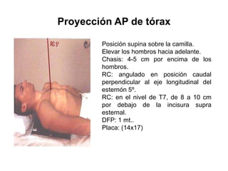 Proyección AP de tórax
Posición supina sobre la camilla.
Elevar los hombros hacia adelante.
Chasis: 4-5 cm por encima de los
hombros.
RC: angulado en posición caudal
perpendicular al eje longitudinal del
esternón 5º.
RC: en el nivel de T7, de 8 a 10 cm
por debajo de la incisura supra
esternal.
DFP: 1 mt..
Placa: (14x17)
 
