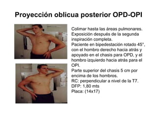 Proyección oblicua posterior OPD-OPI
Colimar hasta las áreas pulmonares.
Exposición después de la segunda
inspiración completa.
Paciente en bipedestación rotado 45°,
con el hombro derecho hacia atrás y
apoyado en el chasis para OPD, y el
hombro izquierdo hacia atrás para el
OPI.
Parte superior del chasis 5 cm por
encima de los hombros.
RC: perpendicular a nivel de la T7.
DFP: 1,80 mts
Placa: (14x17)
 