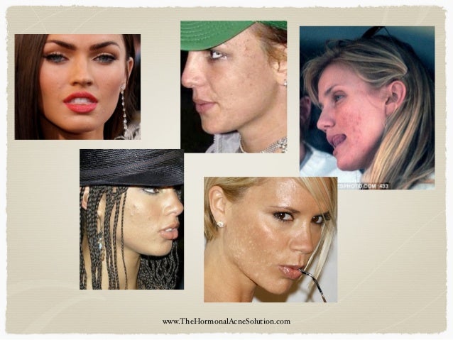 birth control that clears acne