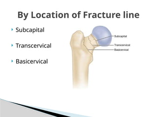 Proximal Femur ORIF by Prof Dr Faheem MAEMON .pptx
